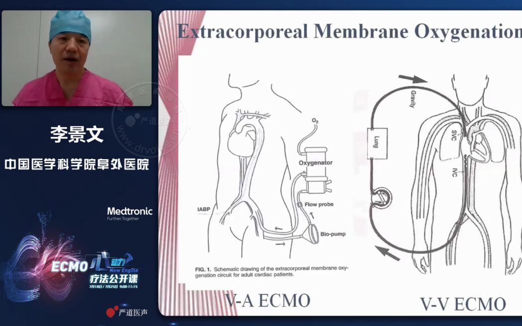 【李景文】VA ECMO物品准备及置管哔哩哔哩bilibili