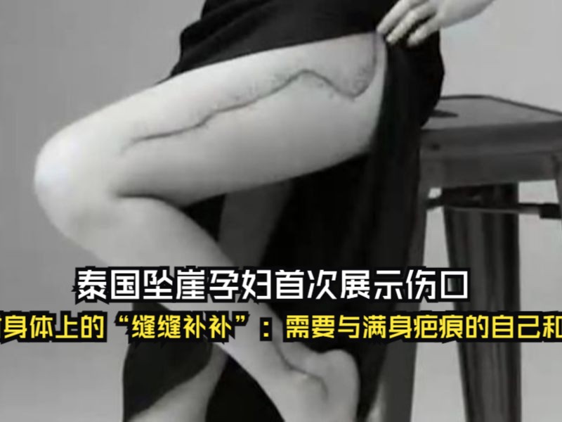 泰国坠崖孕妇首次展示伤口 面对身体上的"缝缝补补":需要与满身疤痕的