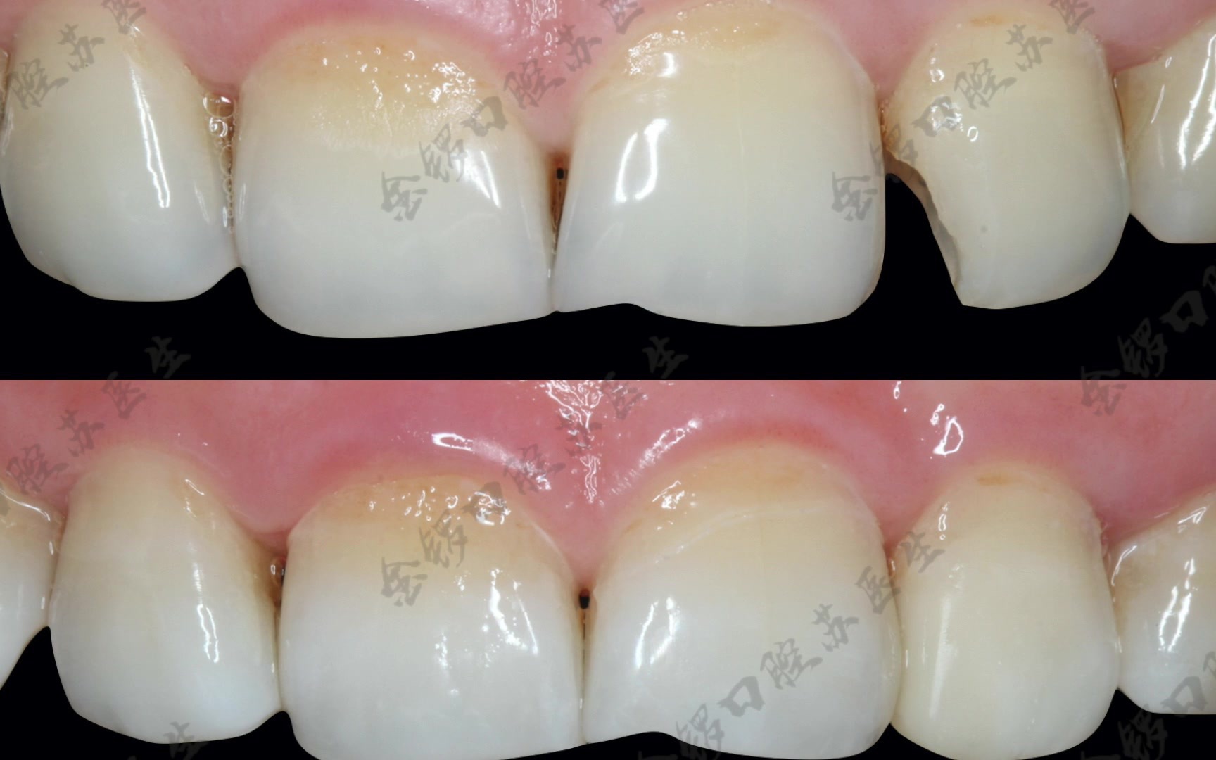 前牙树脂充填一例水印版_哔哩哔哩_bilibili