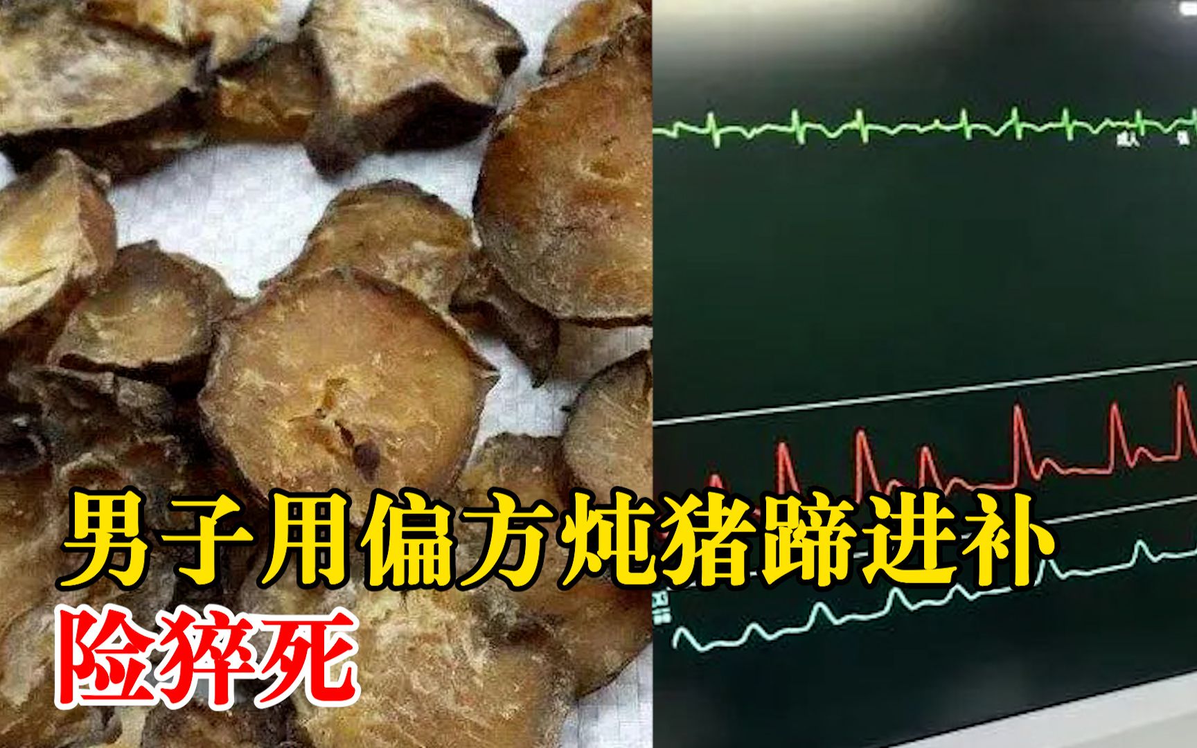 男子用偏方炖猪蹄进补险猝死:用大把生附子炖肉,引发心率失常哔哩哔哩bilibili