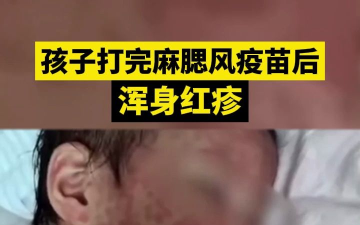 孩子打完麻腮风疫苗后的反应哔哩哔哩bilibili