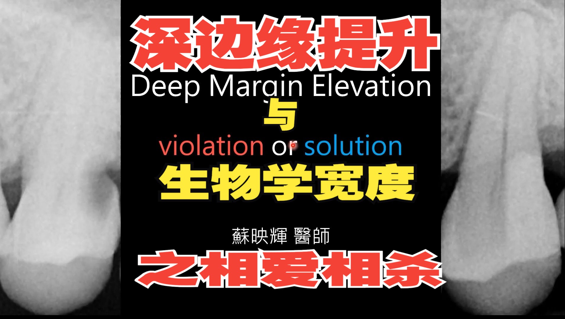 [图]深边缘提升（龈壁提升）与生物学宽度的相爱相杀。Deep Margin Elevation & Biologic Width