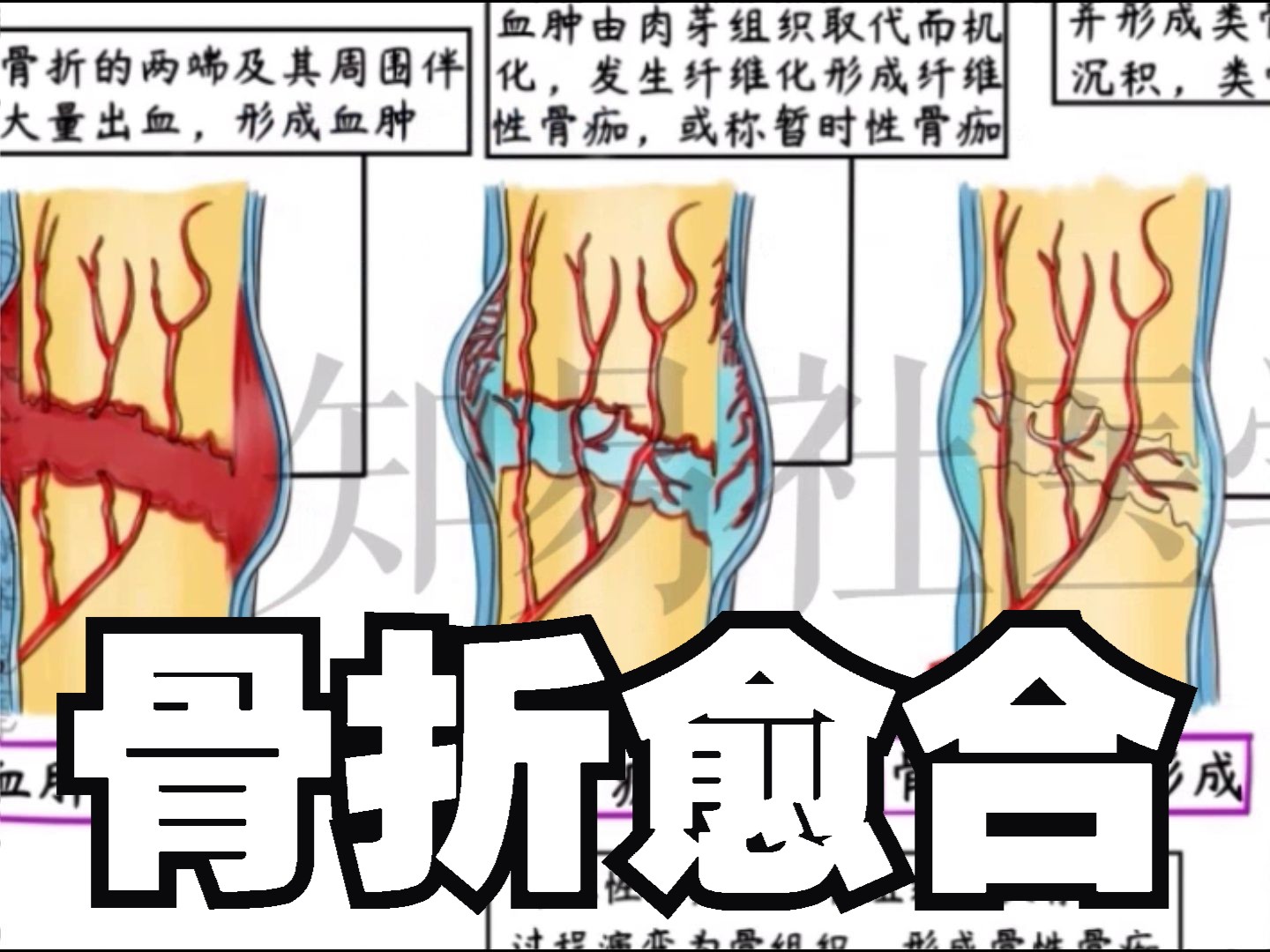 骨折愈合过程图片