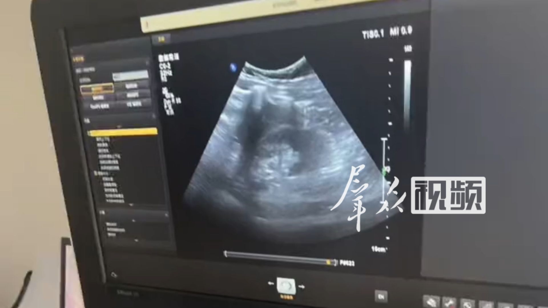女子体检发现约6毫米结节，两家医院检查都没有发现，女子听劝“多查几遍” 最终确诊为早期乳腺癌。医生：隐蔽性强，是超声检查里最容易漏诊的。