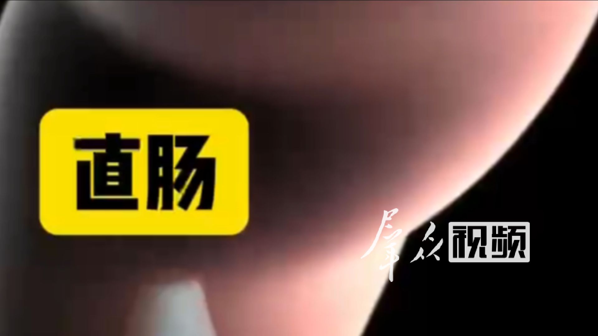 42岁李女士在美容院砸重金买下了号称能“排毒焕亮水光肌”的高端灌肠排毒套餐，结果灌肠时导致肠穿孔，住进了重症监护室。