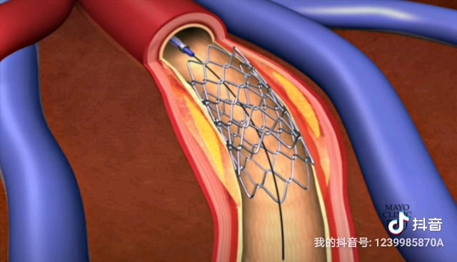 冠脉支架置入术