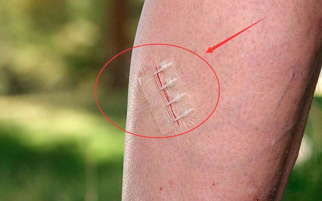 美国发明神奇皮肤"拉链",无需缝针拆线,伤口只需一拉就能闭合