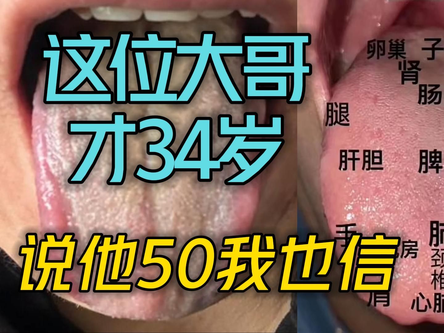 门诊舌象案例分析25:这位大哥才34岁,你说他50我也信哔哩哔哩bilibili