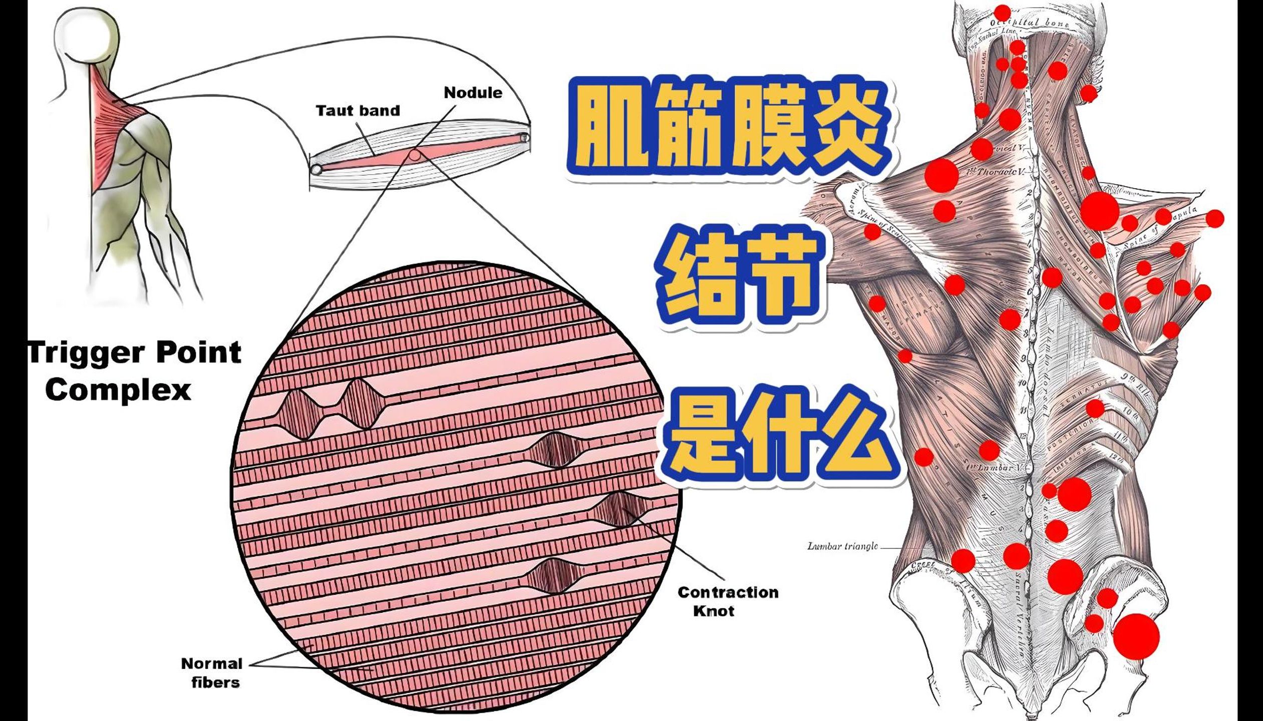 肌筋膜炎?激痛点?结节?这些究竟是什么,一文读懂这些概念以及目前存在的质疑哔哩哔哩bilibili