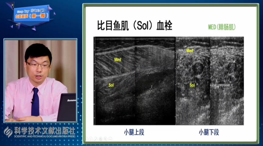 [图]血管超声:静脉血栓的超声诊断01（张勇老师血管超声全套第一季+第二季共18+26集）