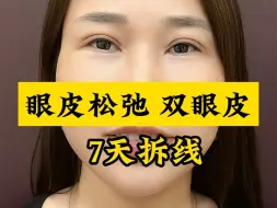 Descargar video: 双眼皮第七天拆线