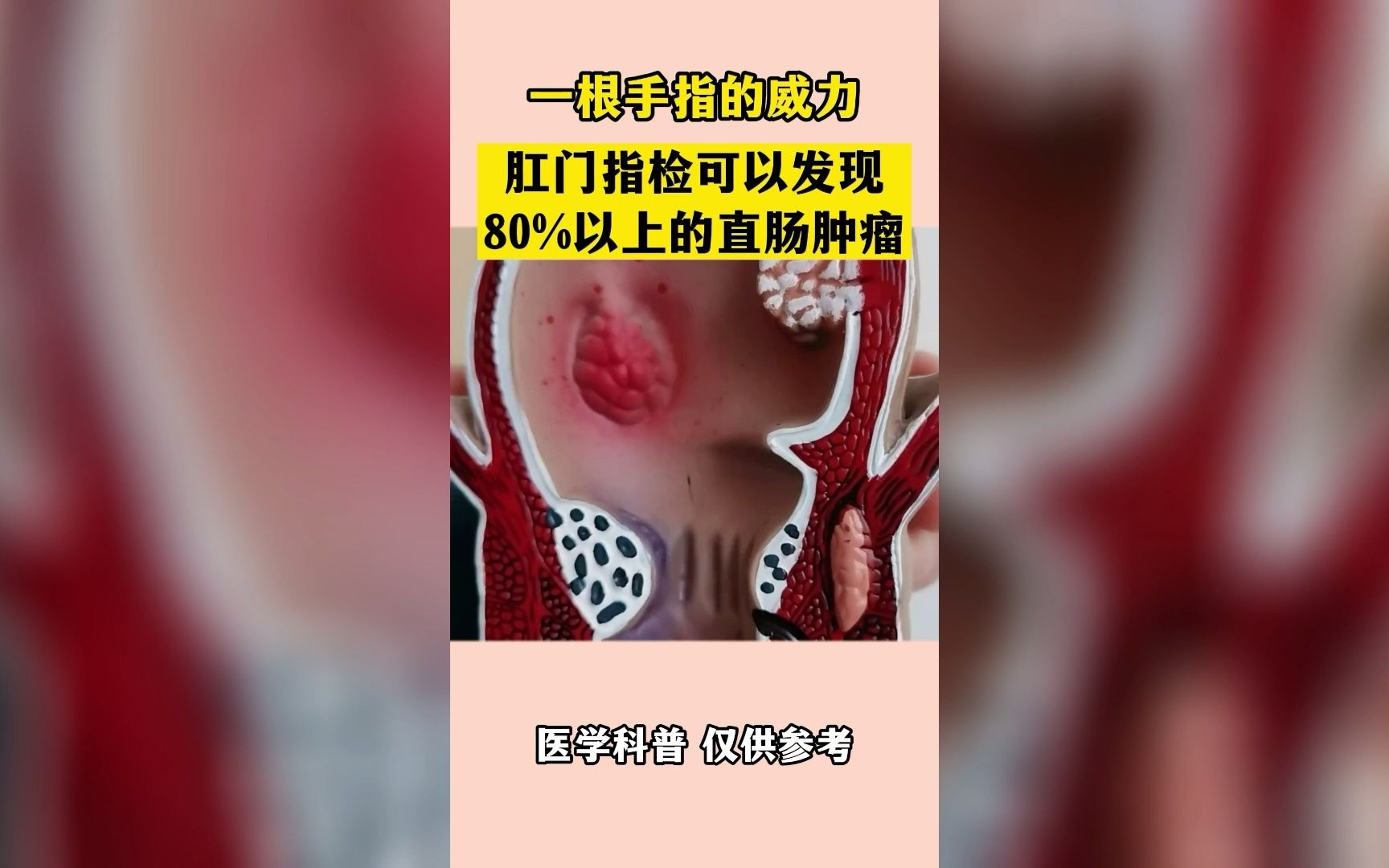 肛門指檢可以發現80以上的直腸腫瘤