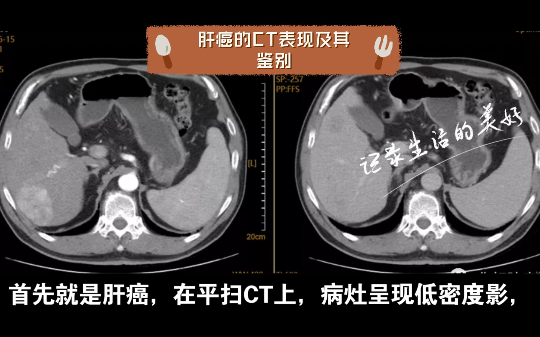 肝癌的CT表现及其鉴别哔哩哔哩bilibili