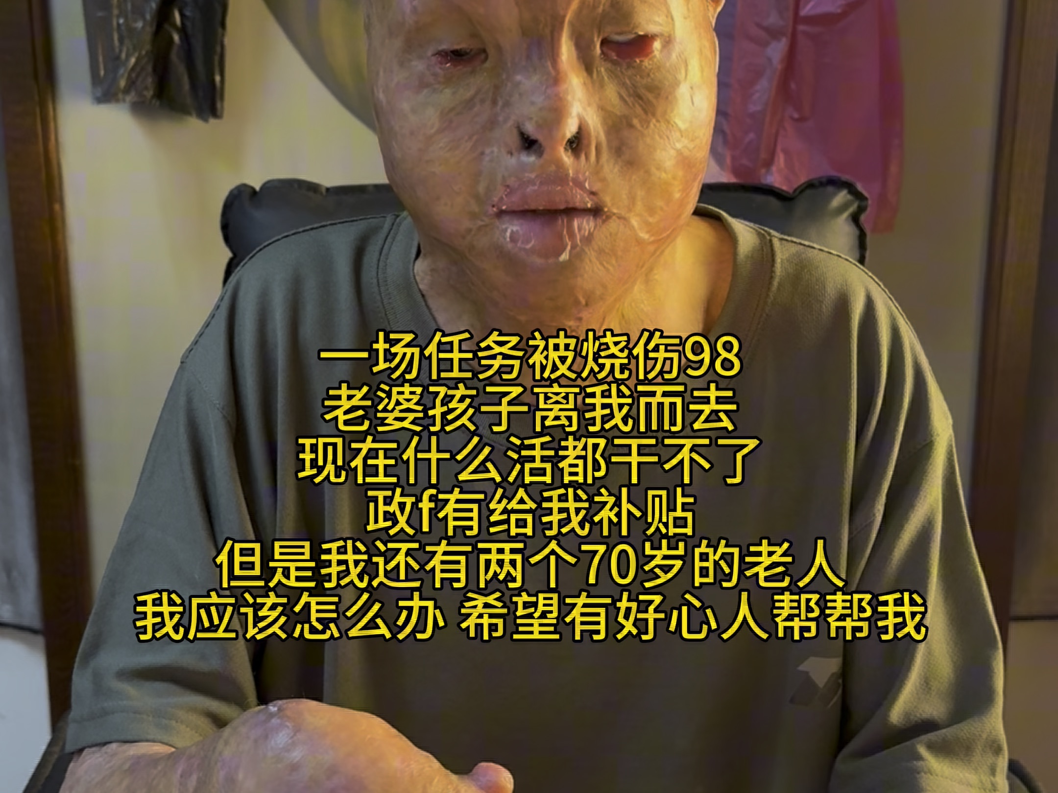 谢谢您刷到我没有划走 烧伤后失去劳动能力 无奈之下~来到网上做网络乞丐 您能给我点个关注吗哔哩哔哩bilibili