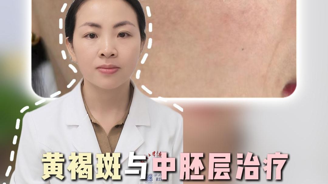 黄褐斑与中胚层治疗：不是打一针就祛斑