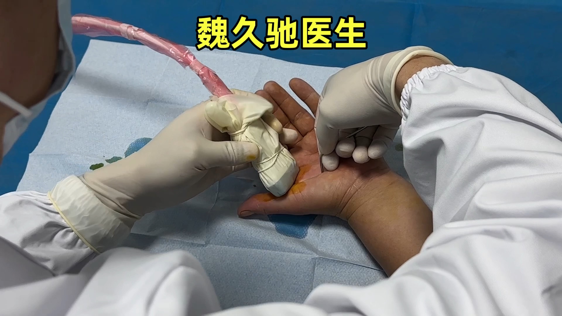 腱鞘炎快速治疗技术:腱鞘导向切开术