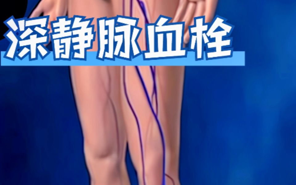 [图]深静脉血栓Deep Vein Thrombosis (DVT)