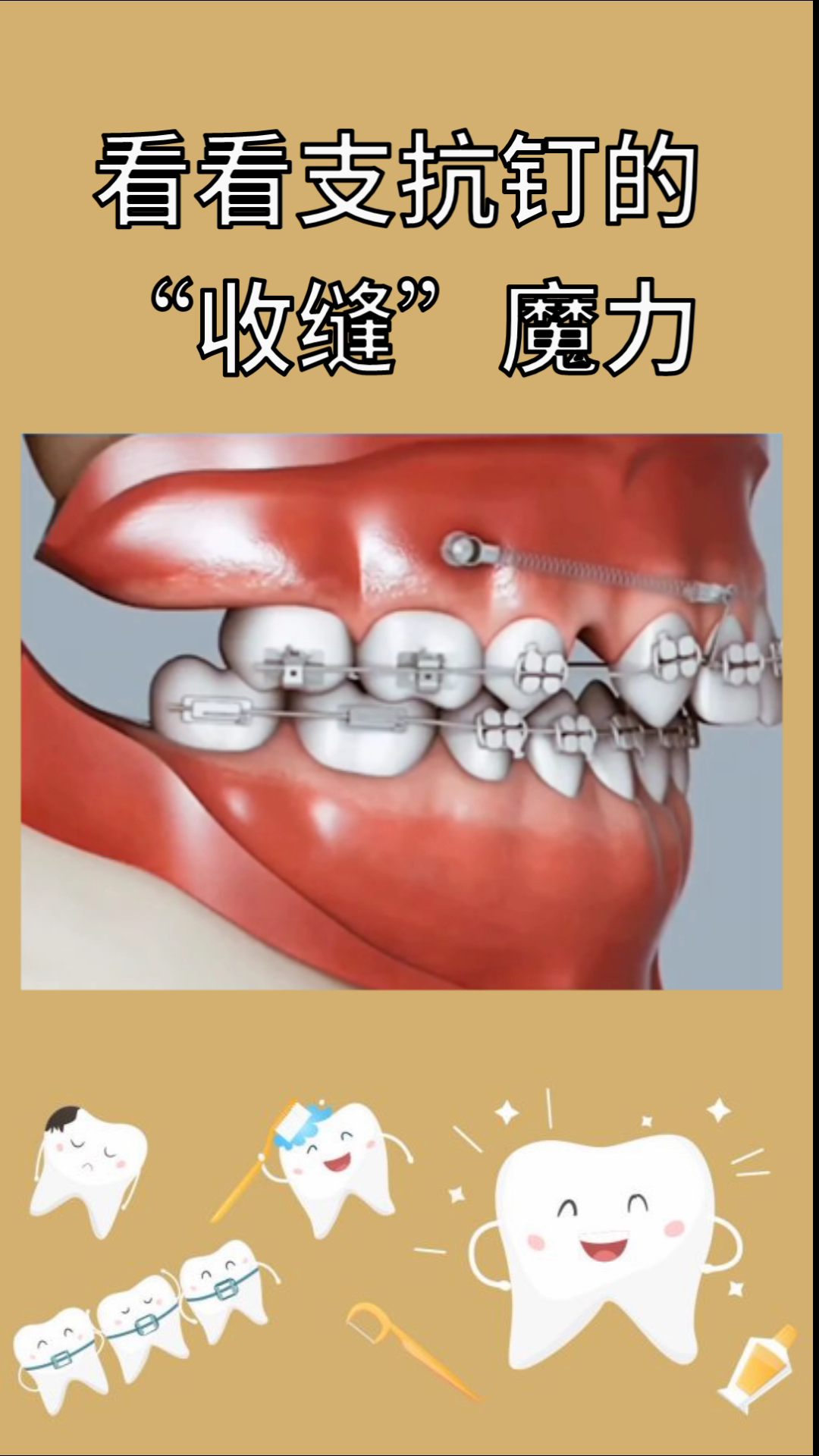 看看支抗钉的收缝魔力支抗钉