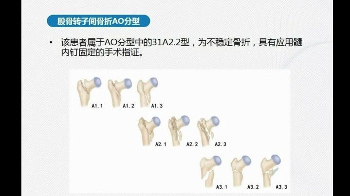 股骨转子间骨折(髓内钉内固定术)哔哩哔哩bilibili