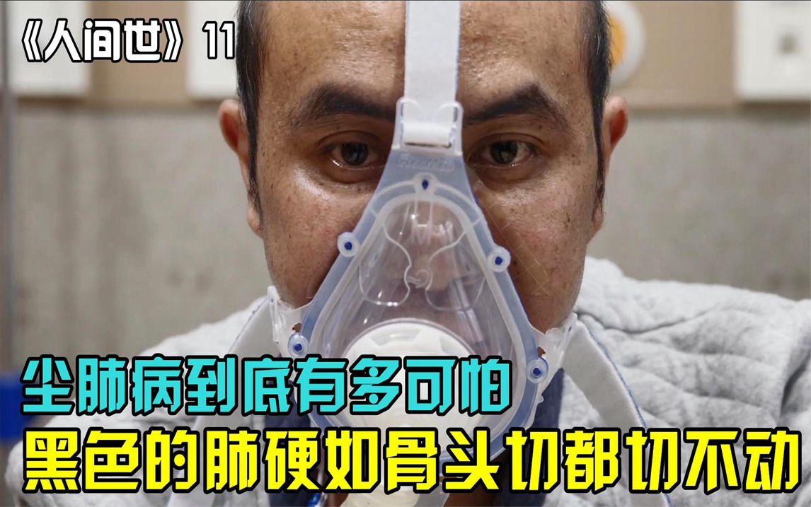 儿子卖车借钱为父亲换肺,取出的肺重如铁,切都切不开《人间世》哔哩哔哩bilibili