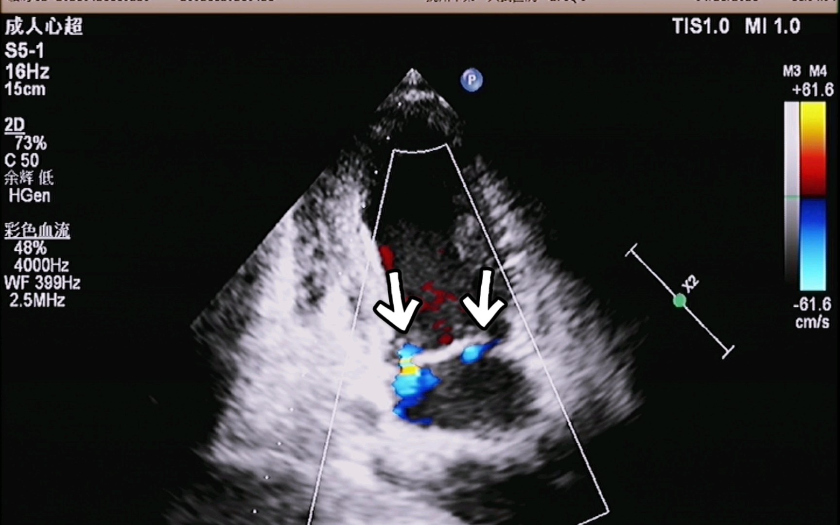 【心超】二尖瓣前叶裂(A3区)哔哩哔哩bilibili