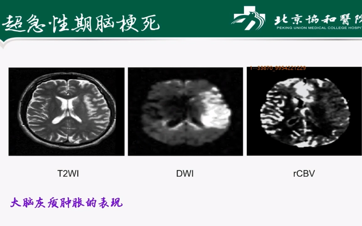 [图]北京协和医院 冯逢-脑血管病的MRI检查要点及诊断思路