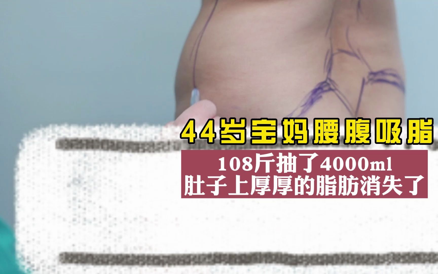 [图]44岁宝妈腰腹吸脂，108斤竟抽出4000ml，肚子上厚厚的脂肪消失了