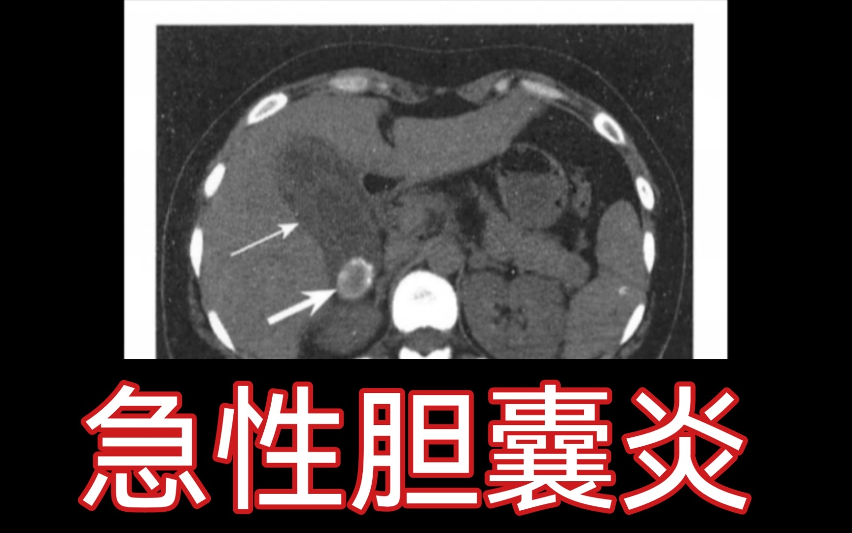 【医学影像】跟我一起刷病例 |急性胆囊炎哔哩哔哩bilibili