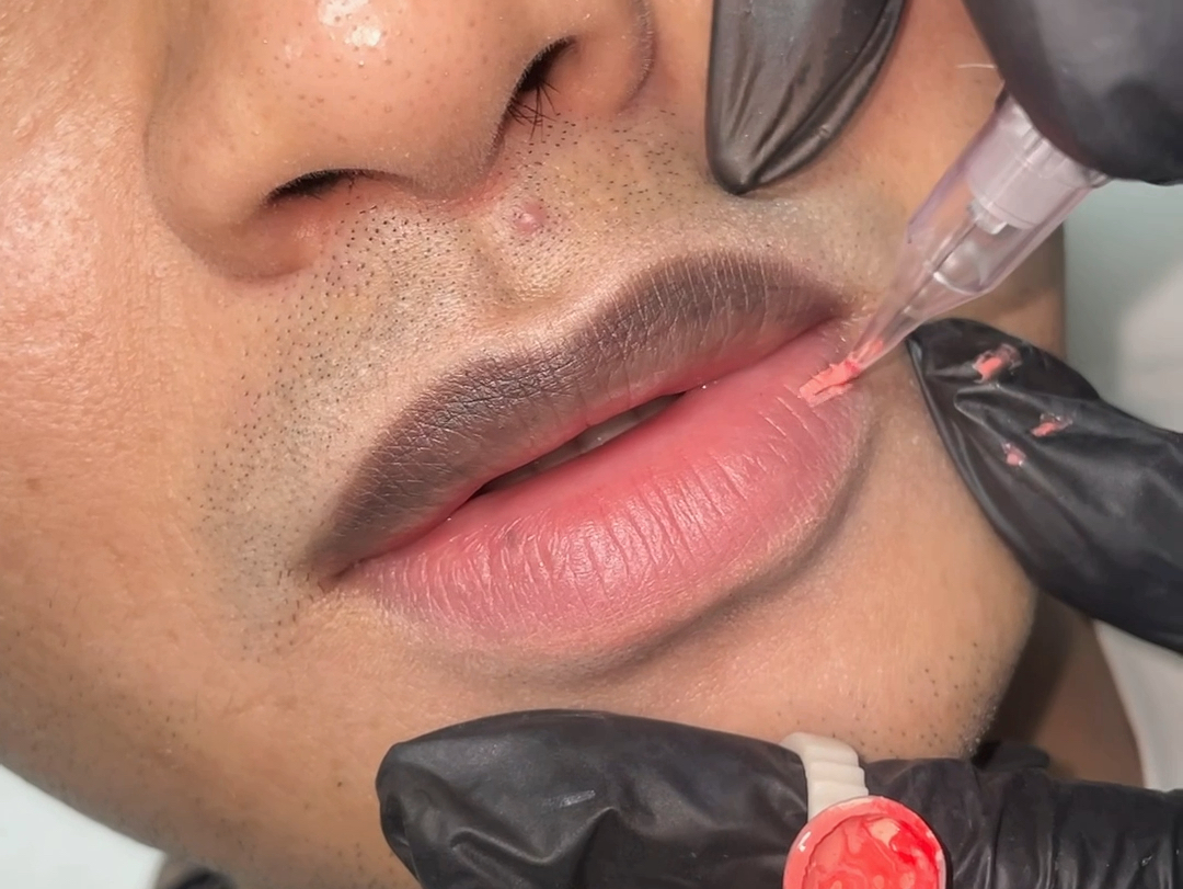 男士矫正乌唇,还原健康唇色