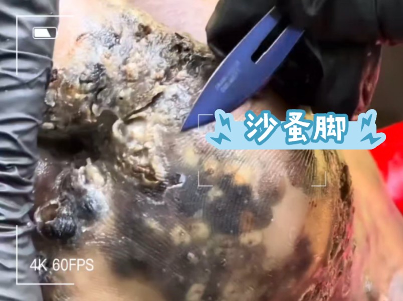 这个脚已经被沙蚤寄生了