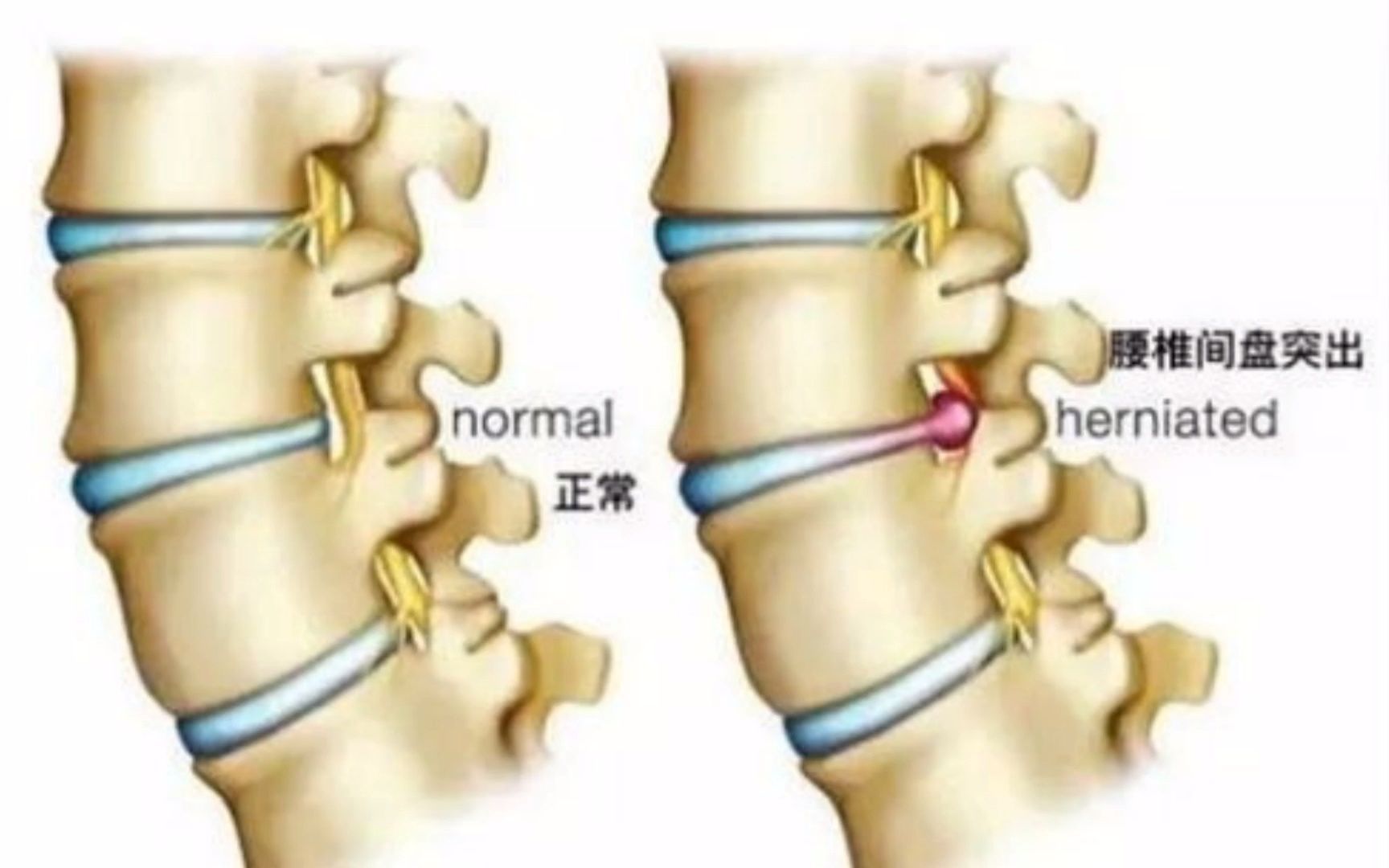 快讯:医疗部再现惊人举措!腰椎间盘突出最佳的治愈方法终于被曝光了,效果竟然秒杀手术!哔哩哔哩bilibili