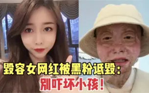 Download Video: 毁容女网红被黑粉诋毁，前追求者：以前看不上我现在送我都不要