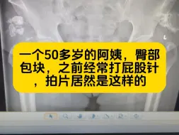 Tải video: 屁股针打到长肿块可能需要手术