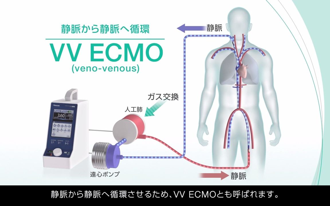 テルモ株式会社「体外式膜型人工肺(ECMO)について」(2021年)介绍哔哩哔哩bilibili