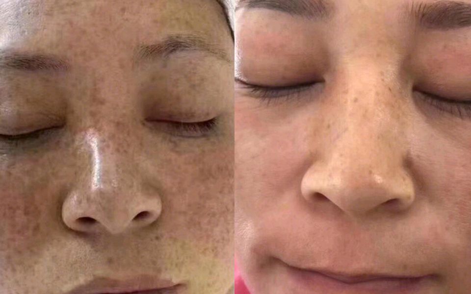 精华液有什么功效!过来人分享的祛斑妙招,朋友圈超万人转发!
