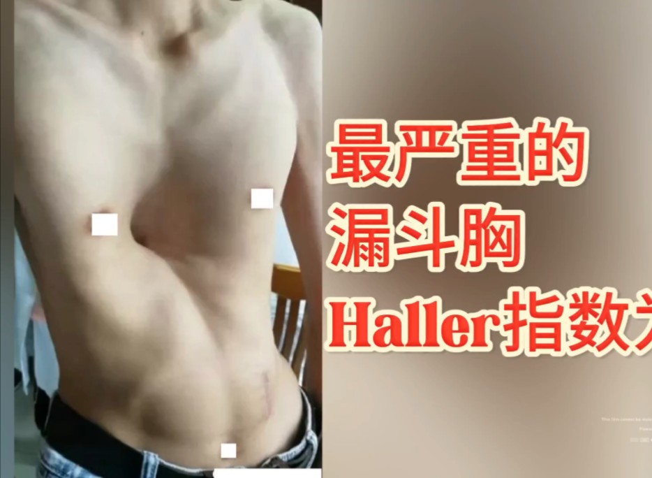 最严重的漏斗胸你见过吗?Haller指数达负值.怎么治疗?哔哩哔哩bilibili