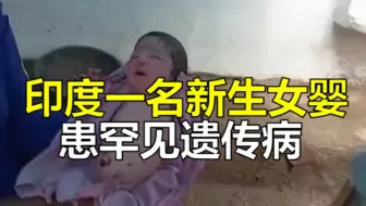 印度一名新生女婴患罕见遗传病 海豹肢症 出生时四肢缺失 哔哩哔哩 Bilibili