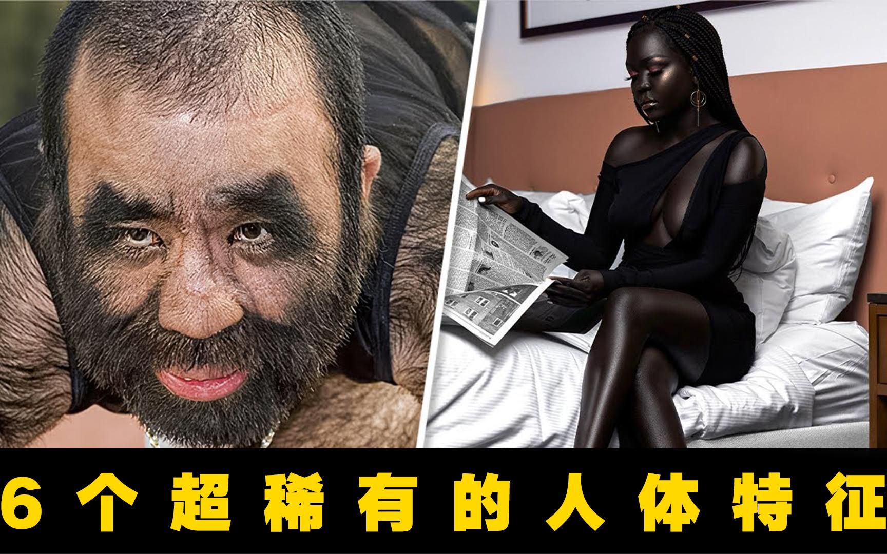 6个超稀有的人体特征!96%的皮肤布满毛发,被人戏称"穴居人"!