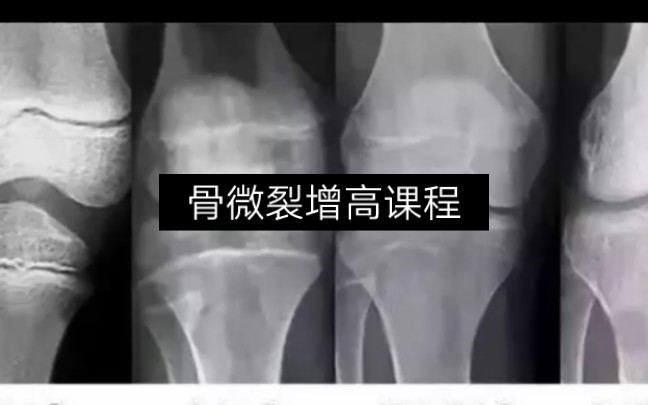 骨微裂增高课程