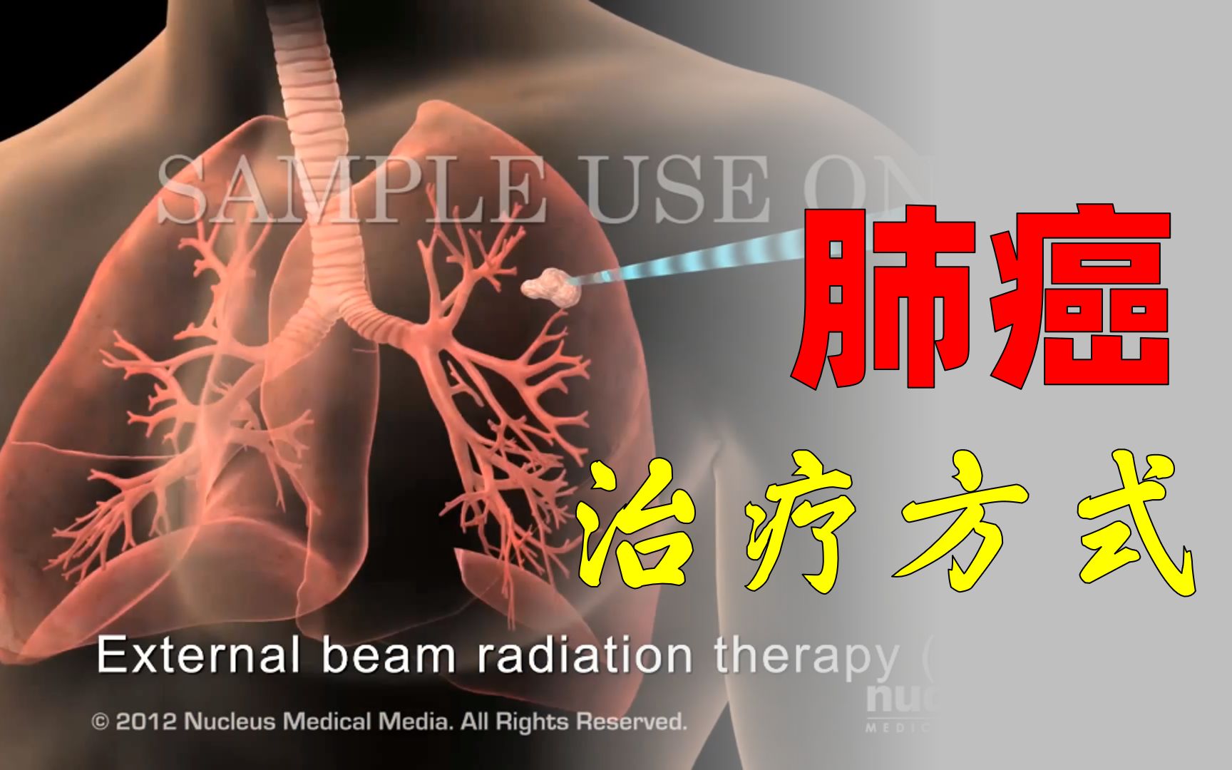 【3D医学动画】肺癌治疗哔哩哔哩bilibili