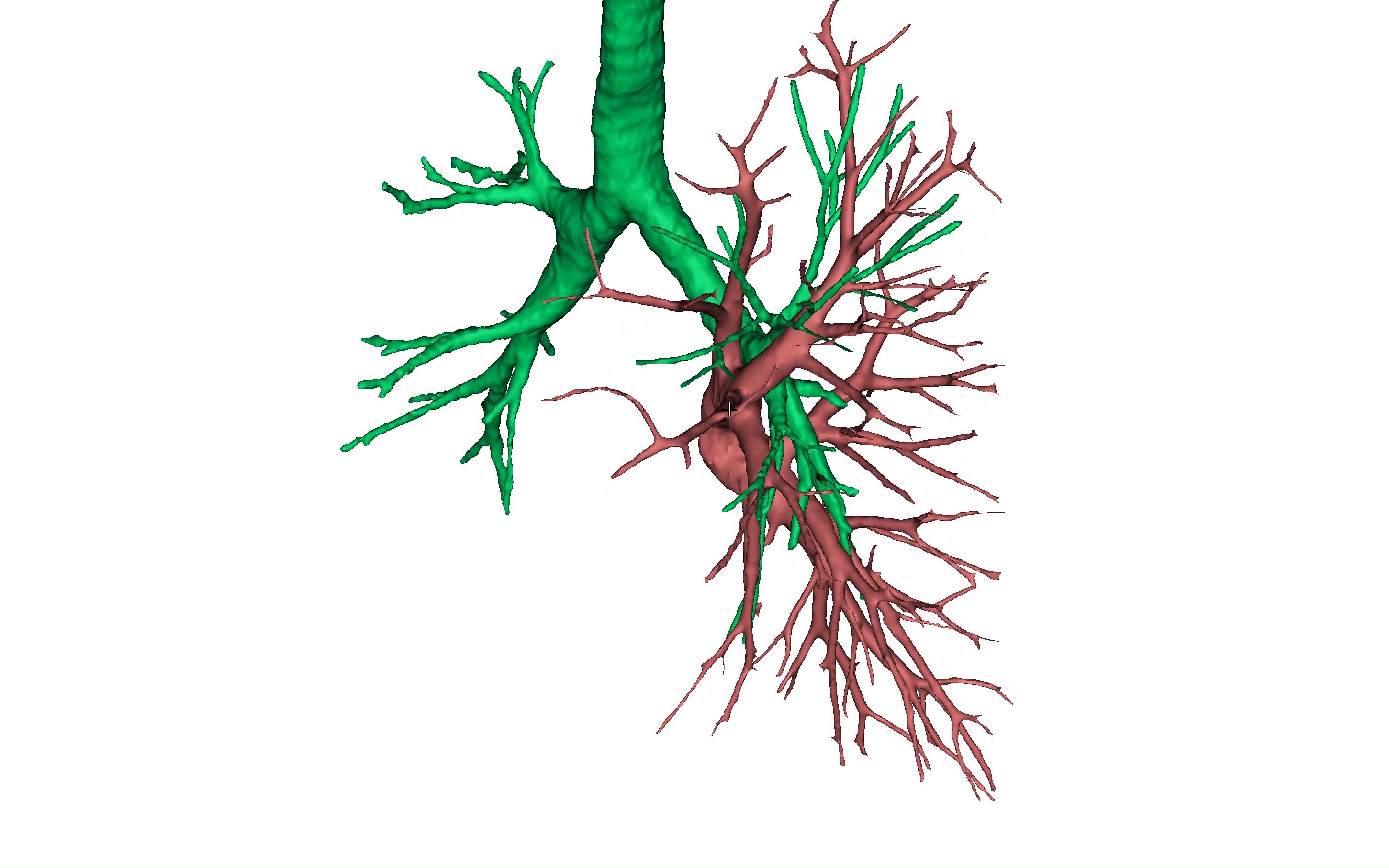 左肺上叶固有段内部静脉回流类型——第二型