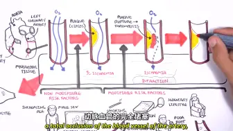 Скачать видео: 急性冠状动脉综合征（心绞痛 心肌梗死） Part 1 | Acute coronary syndrome Part 1