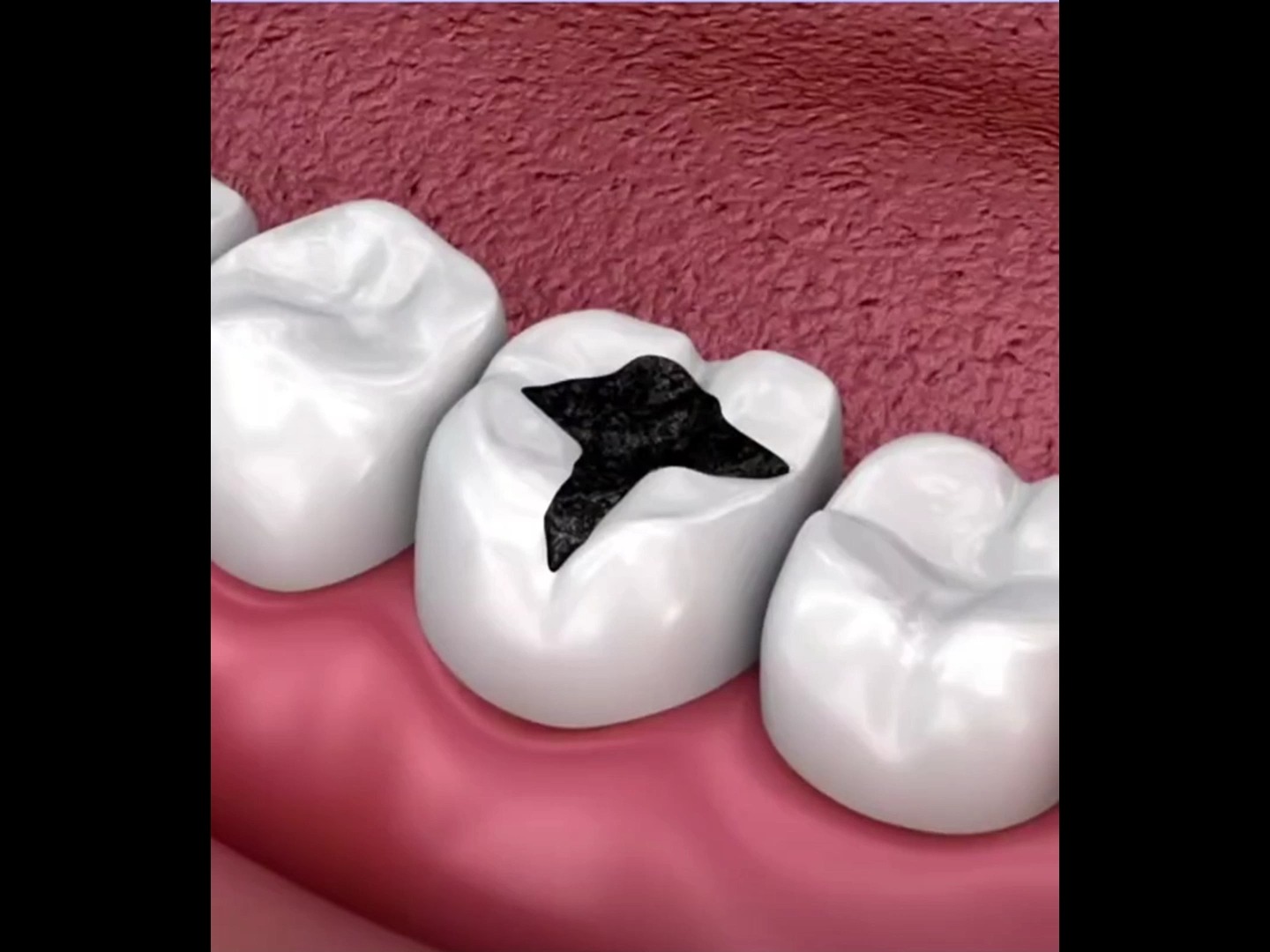 15秒看完补牙全过程