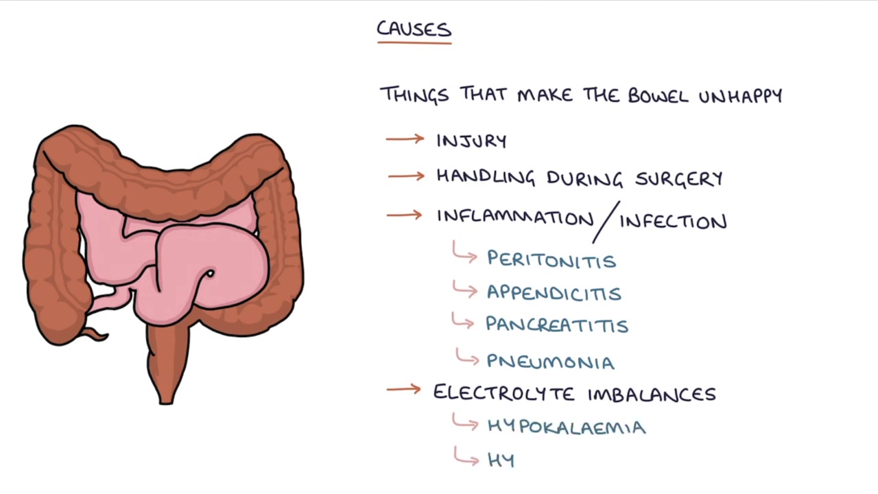 understanding ileus (paralytic ileus)