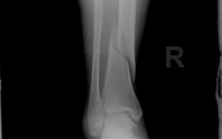 医学影像学x光 右侧胫骨中下段骨折,右胫骨后踝骨折,右腓骨外踝骨折,伴关节周围软组织损伤.哔哩哔哩bilibili