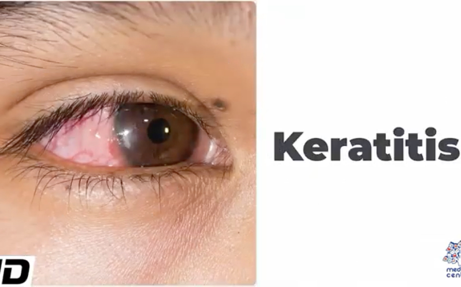 角膜炎的病因,症状,体征,诊断和治疗