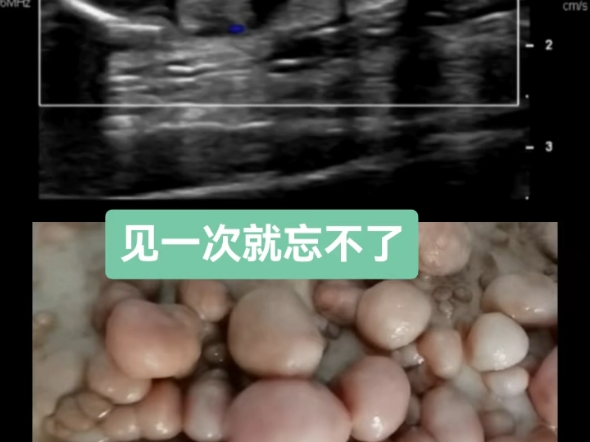 典型的I型神经纤维瘤病的超声声像图表现分为结节型、丛状型和弥漫型三种类型哔哩哔哩bilibili