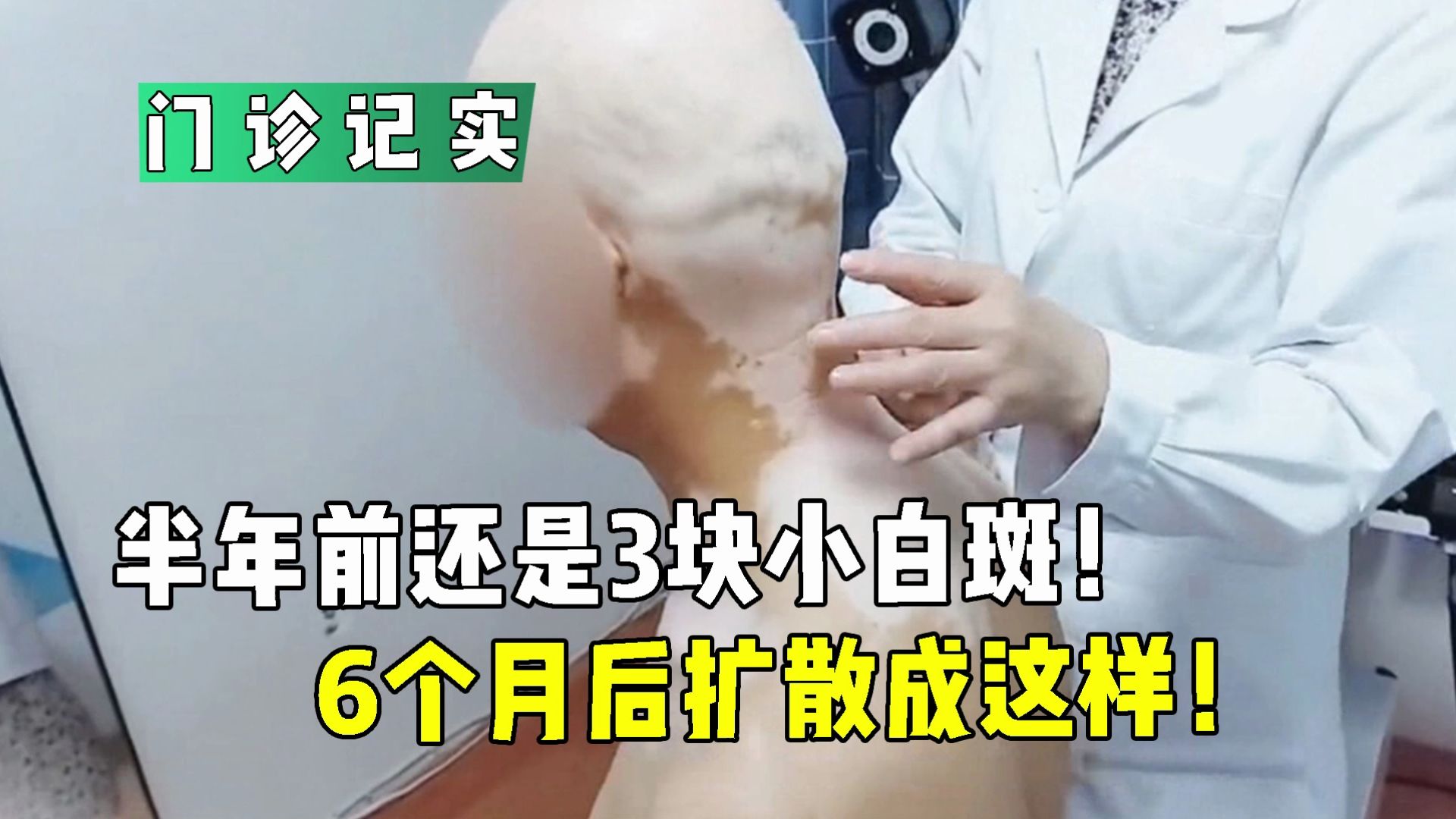 6个月后扩散成这样!#白癜风