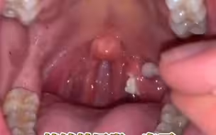 扁桃体结石典型症状