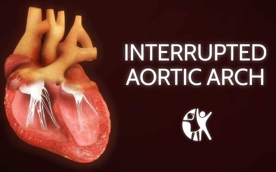 aortic arch图片